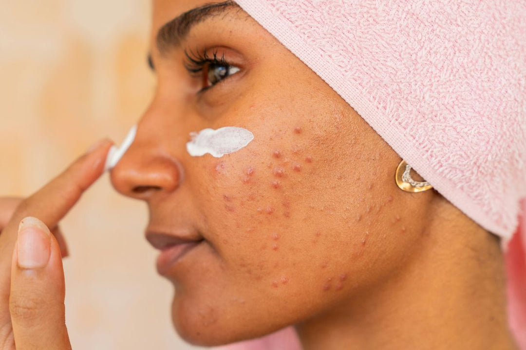 acne op dezelfde plaats